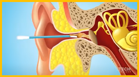 귀에 이물질 제거