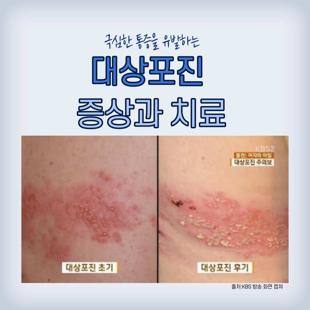 대상포진 초기증상 5가지