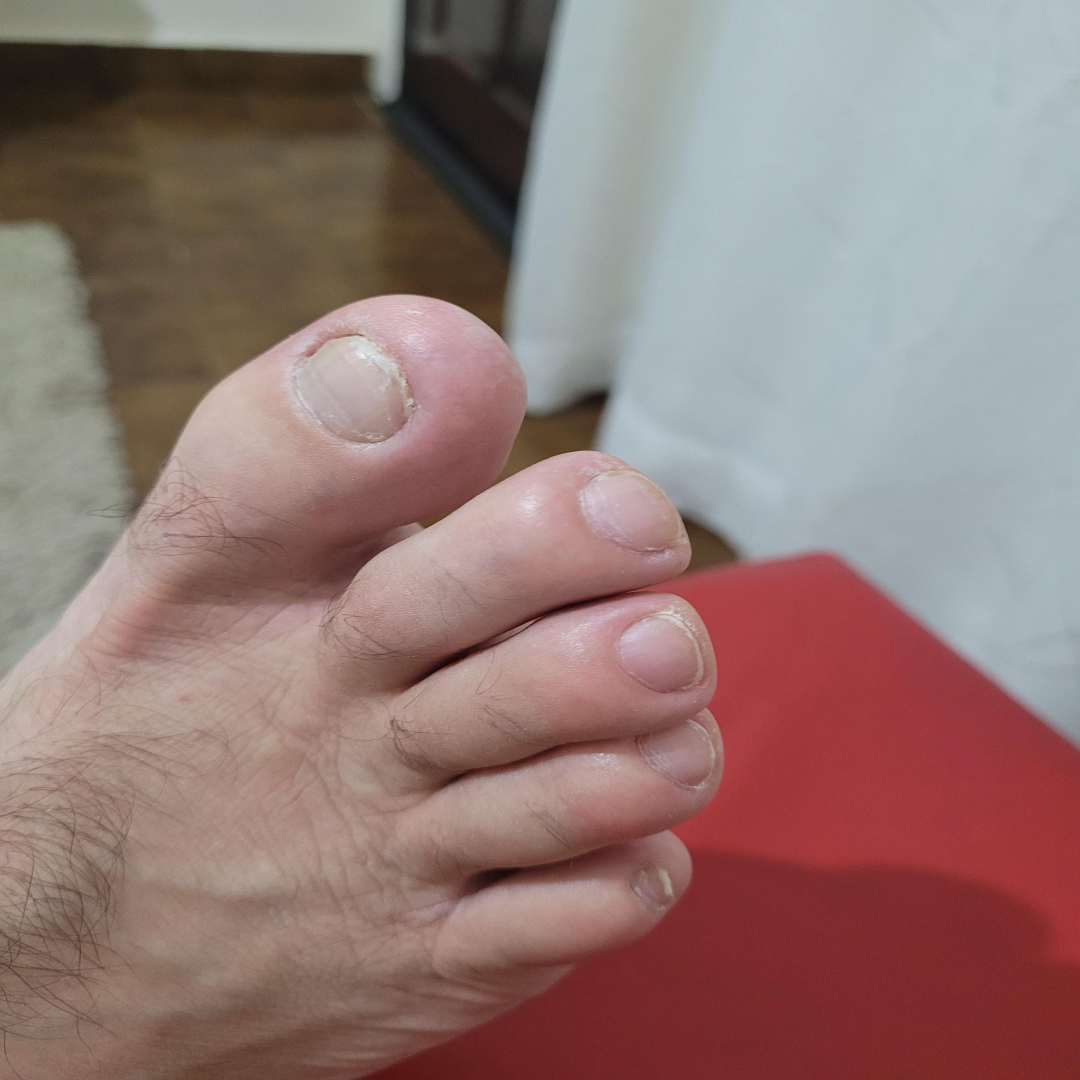  통풍 증상과 치료와 예방법