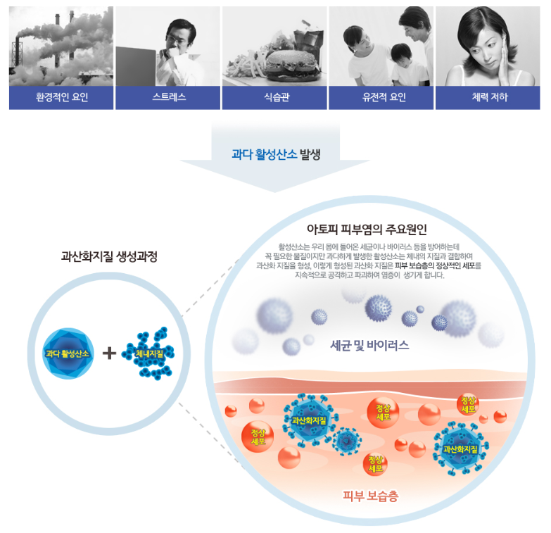 아토피의 원인