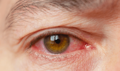 코로나 XBB의 특징으로 결막염이 있어서 결막염에 걸린 사람의 오른쪽 눈을 찍은 사진