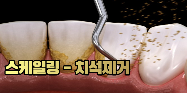 치석제거 사진