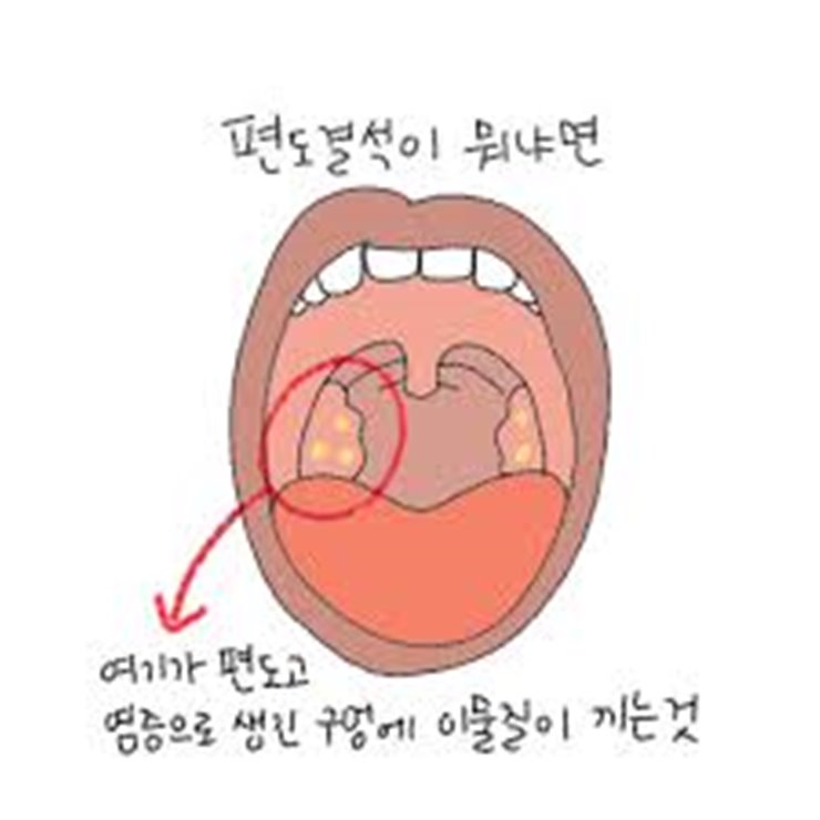  편도결석 원인 및 증상과 제거방법