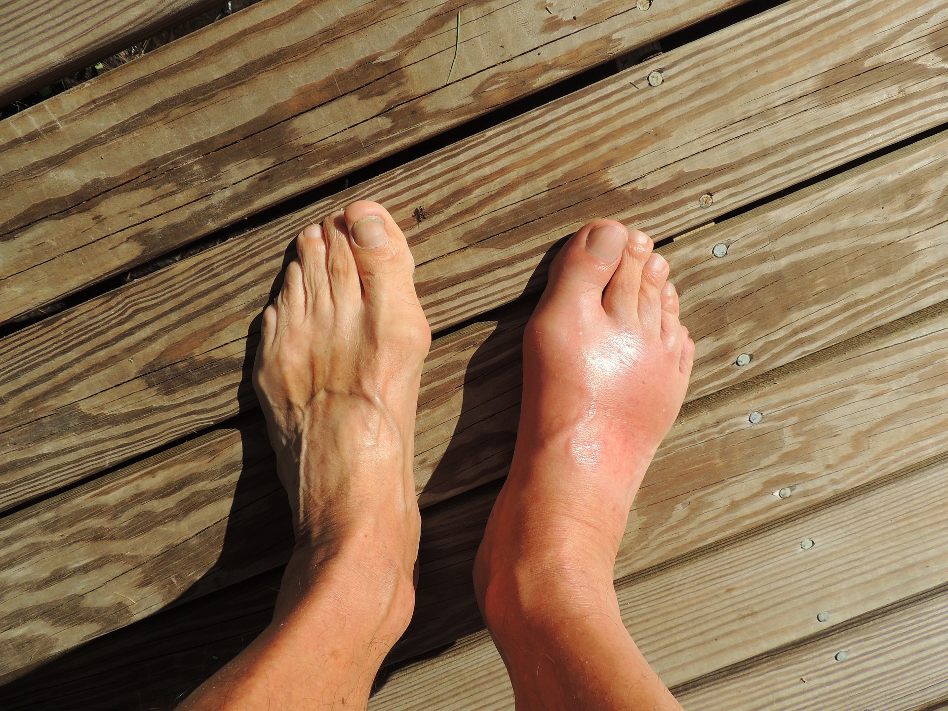 양쪽 발을 비교를 했을 때&#44; 통풍으로 인한 염증으로 오른 쪽 발등과 발가락이 왼쪽에 비해서 월등히 붓고&#44; 벌겋게 부어 있는 통풍 환자의 발 사진