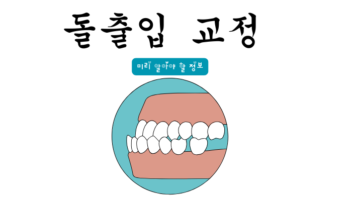 돌출입 교정 전 반드시 알아야 할 사항들