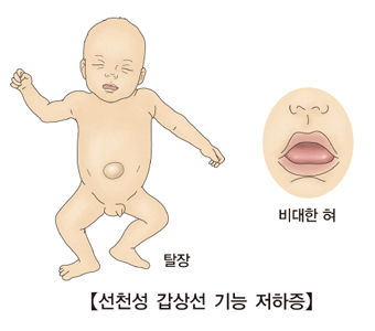 갑상선 사진