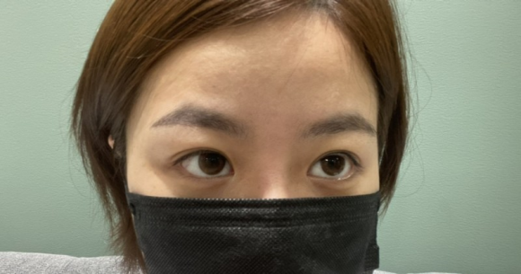 이마필러잘하는곳 후기! 17