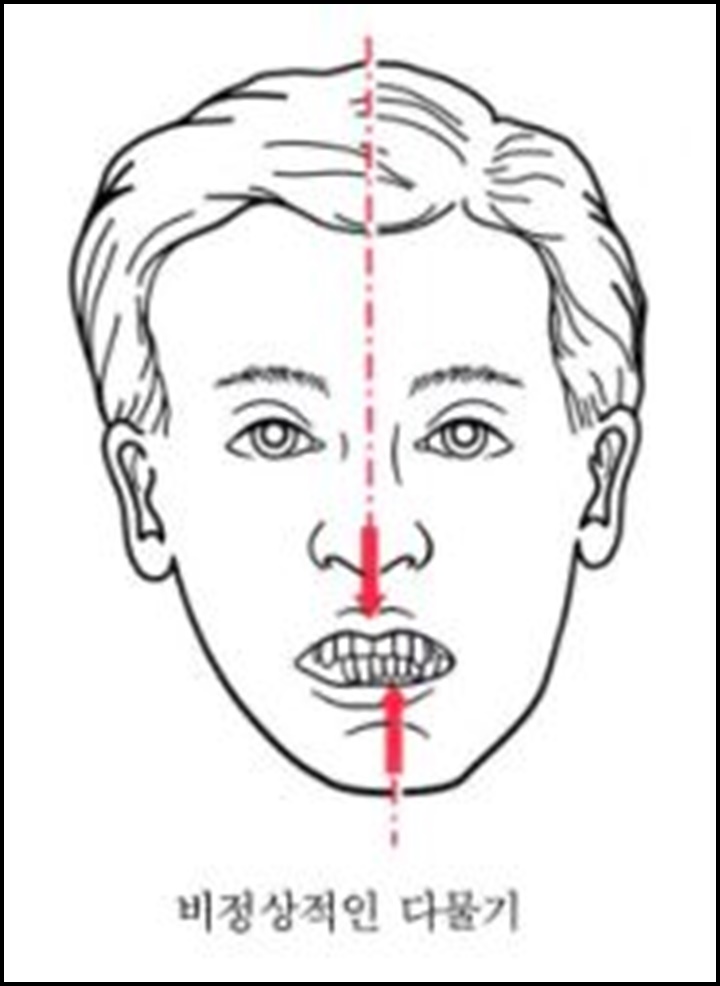 턱관절의 부정렬로 인해서 치아가 맞지 않는 부정교합이 발생한 그림