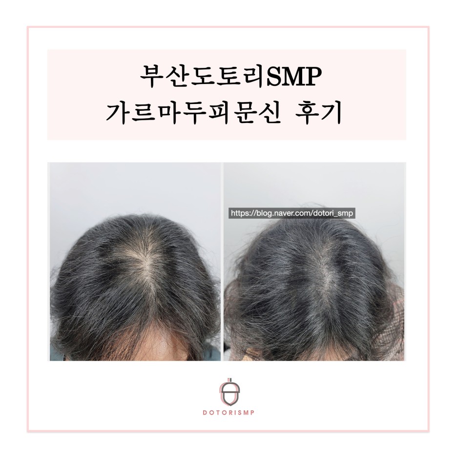  부산 도토리 SMP 가르마 두피문신 후기
