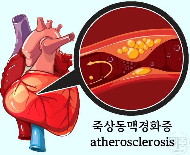 콜레스테롤 낮추는 영양제 추천 동맥경화증영양제