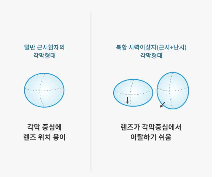 드림렌즈 가격 효과 착용기간 후기