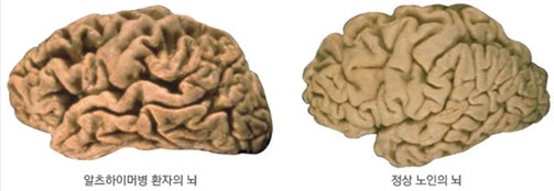 알츠하이머병 환자의 뇌