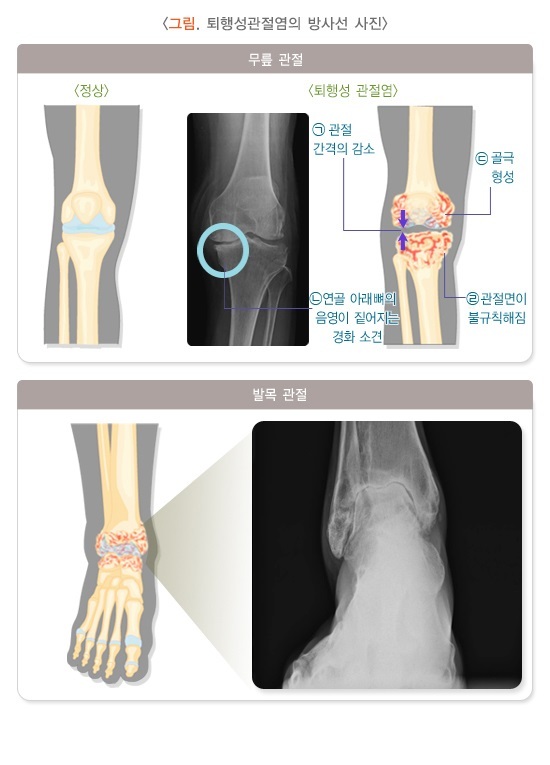  골관절염 증상과 치료 방법