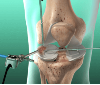 파열된 반월판 연골 관절 내시경 수술 사진
