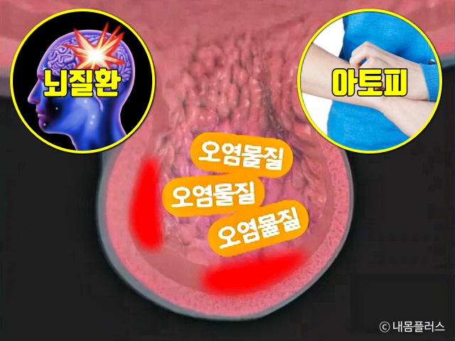 장에 독소가 쌓이면 나타나는 증상, 장독소배출방법 장독소자가진단, 장게실염 대장암, 건강 팁줌 매일꿀정보