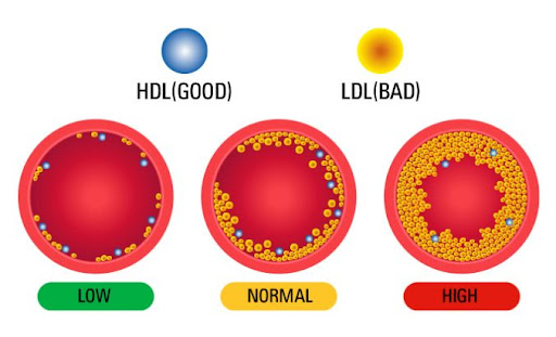 LDL 콜레스테롤 낮추는 방법