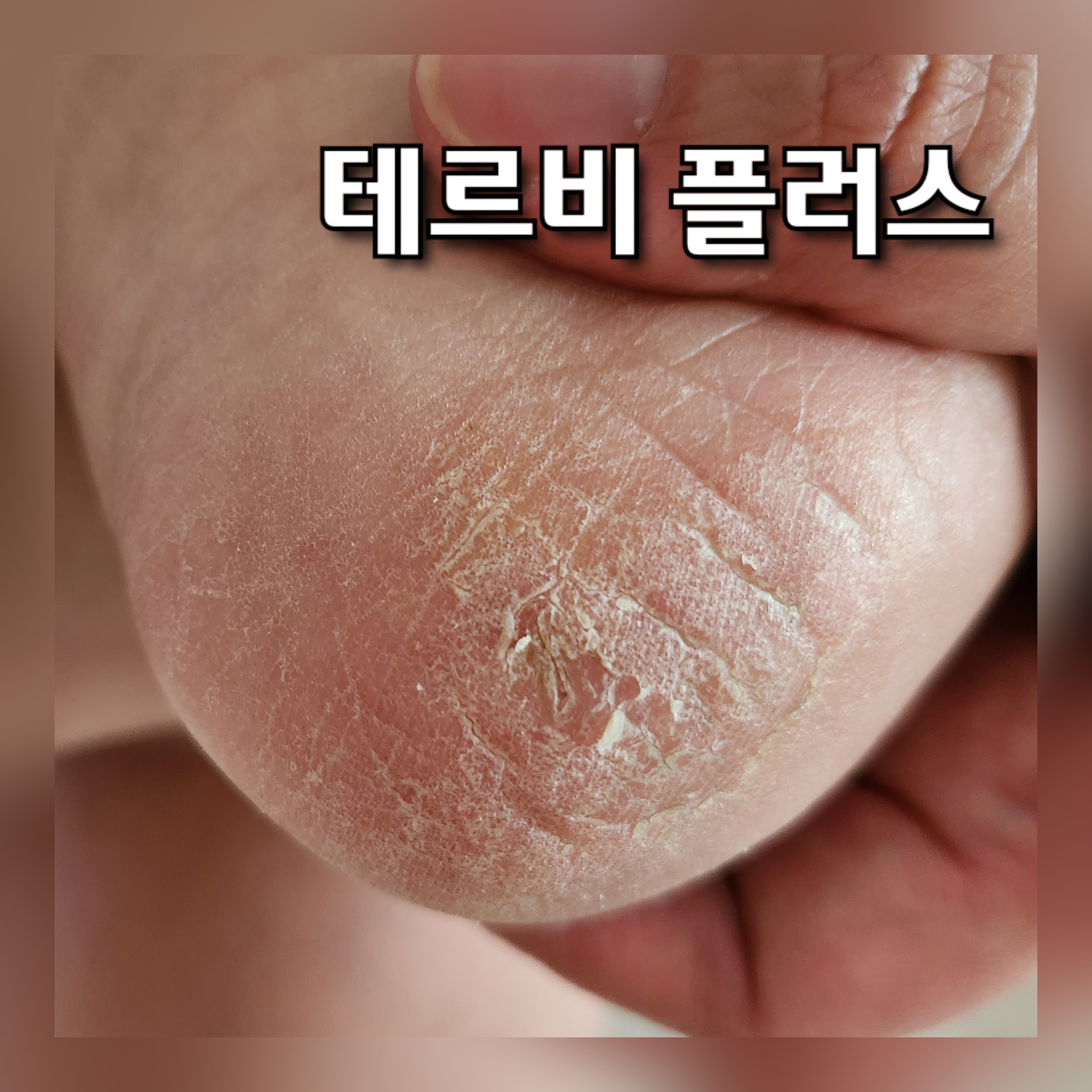 테르비플러스연고