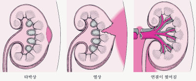 신장 기능이 좋지 않은 증상입니다.