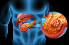  췌장암(pancreatic cancer)이란?