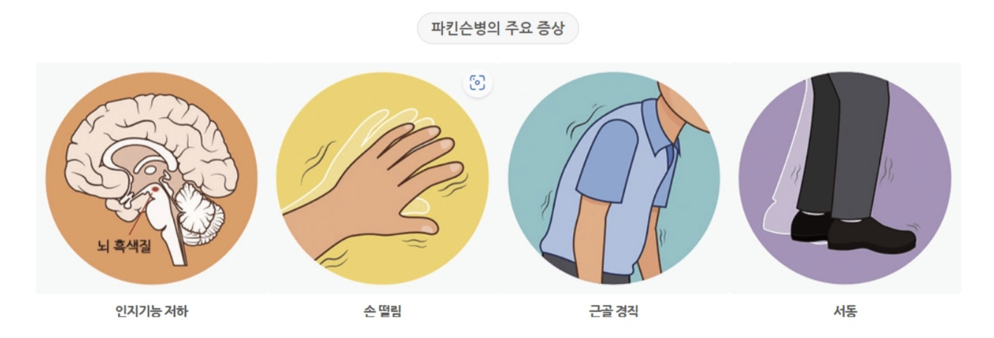 파킨슨병의 신경계 퇴행성 질환