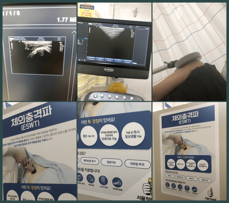 오십견 어깨통증 체외충격파 치료