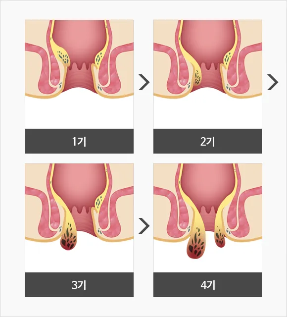 치핵12