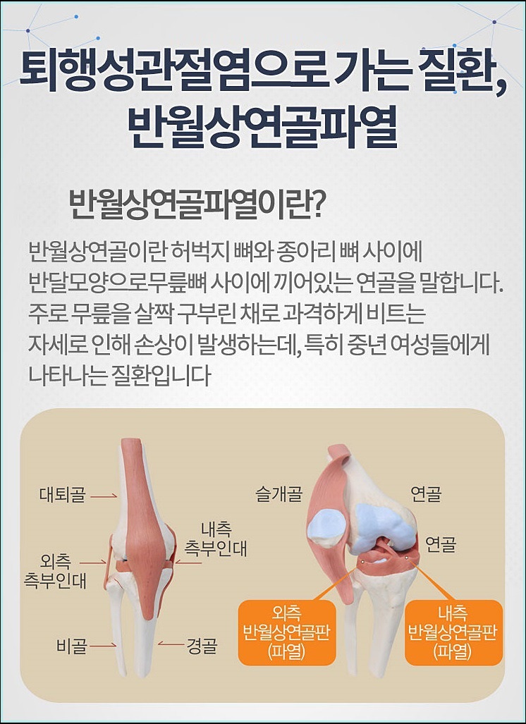  반월상연골파열이란?