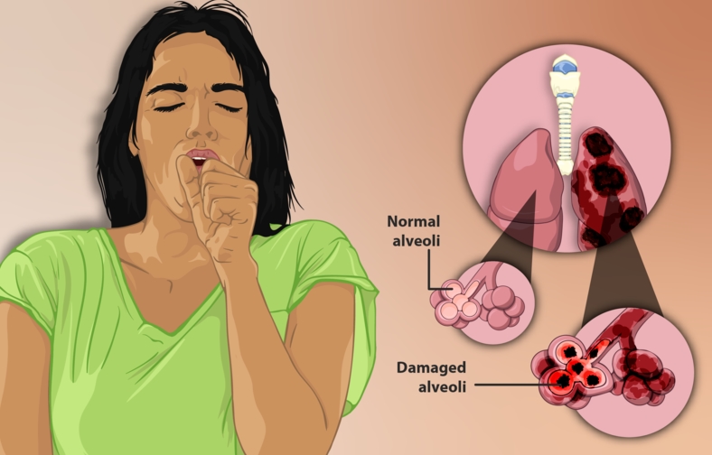 다양한 유형의 폐 질환 종류