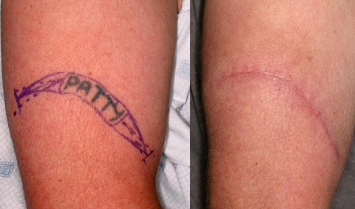 surgical removal of tattoo