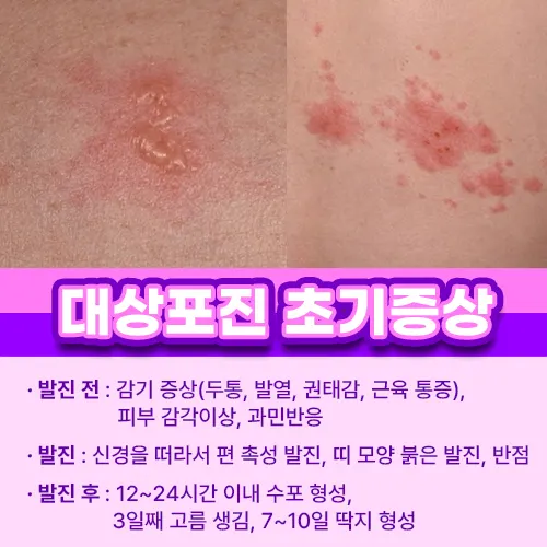 대상포진 초기증상