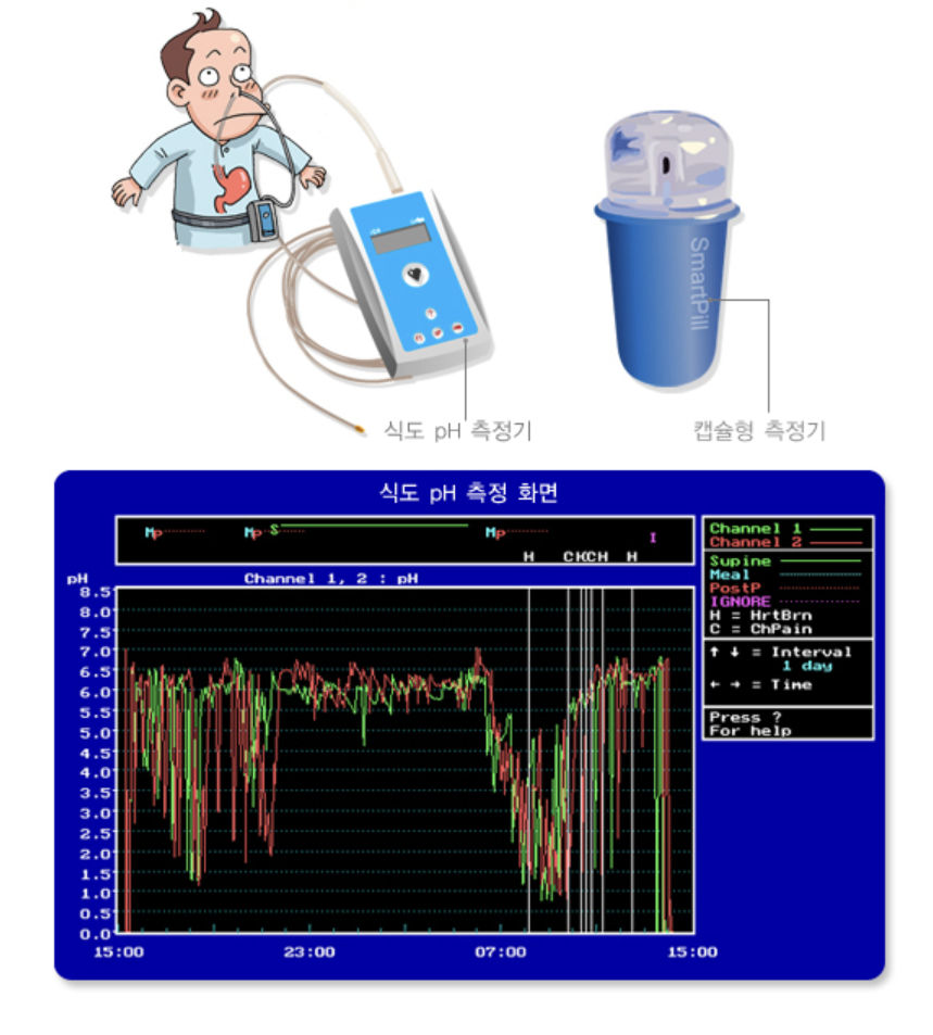24시간 식도 PH 검사