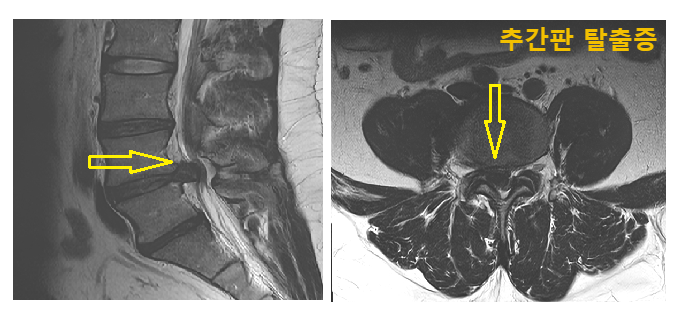 추간판 탈출증의 MRI 소견