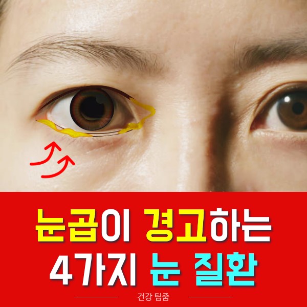 고름 노란 눈곱이 끼는 이유 눈질환 아폴로 눈병 결막염 증상 충혈, 건강 팁줌 매일꿀정보