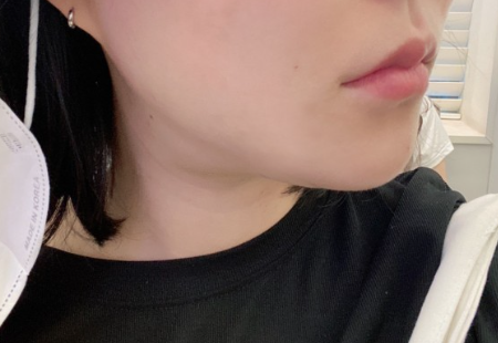  침샘보톡스 후기, 효과보려면 이런 사람만 하는게 좋음
