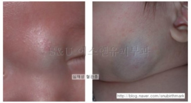 심부 영아 혈관종, 헤만디올 복용 5개월 후