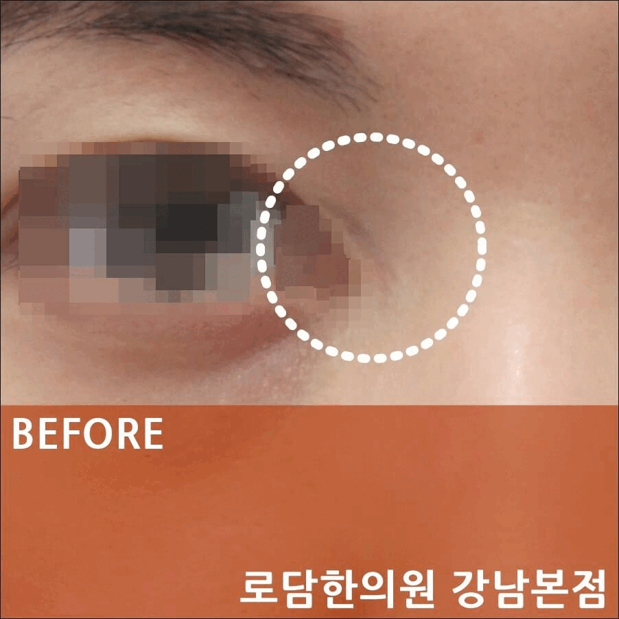  눈 앞트임 자국 파인 흉터 치료 과정 새살침 코라테라피
