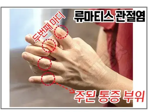 손가락-류마티스-관절염-증상