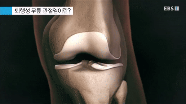  퇴행성 관절염, 수술 받아야 하나?