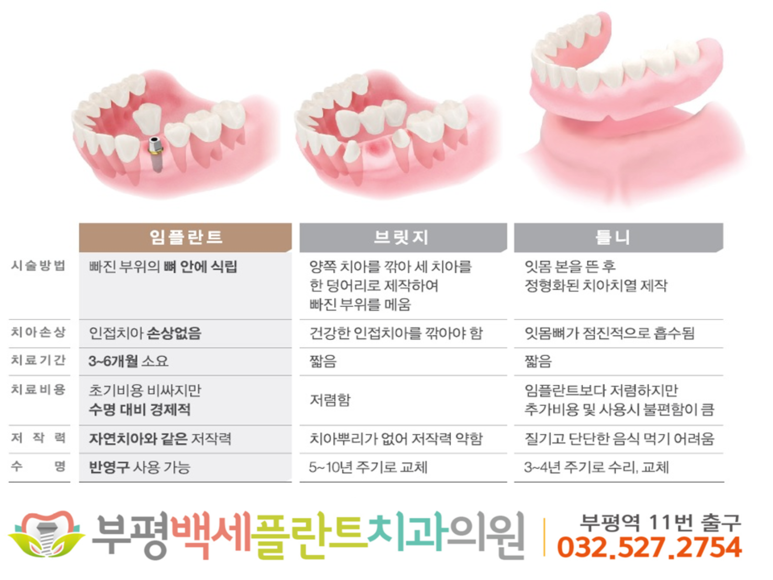 구월동 치과 임플란트 틀니 가격 차이가 나는 이유