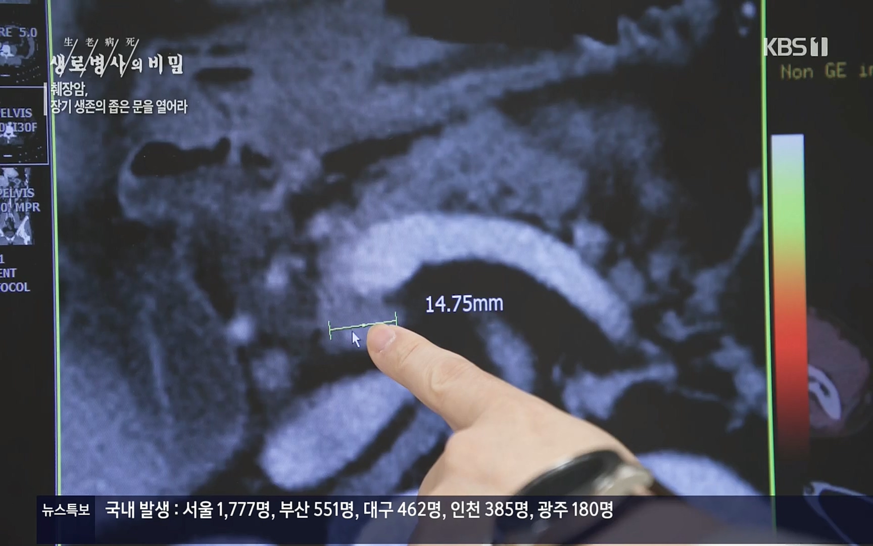 생로병사의 비밀.E823.220622p.H264-F1RST.mp4_20220624_210524.025.jpg