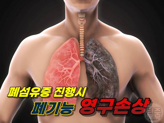 폐 굳는 병 폐섬유증 원인 폐암 전단계 코로나후유증