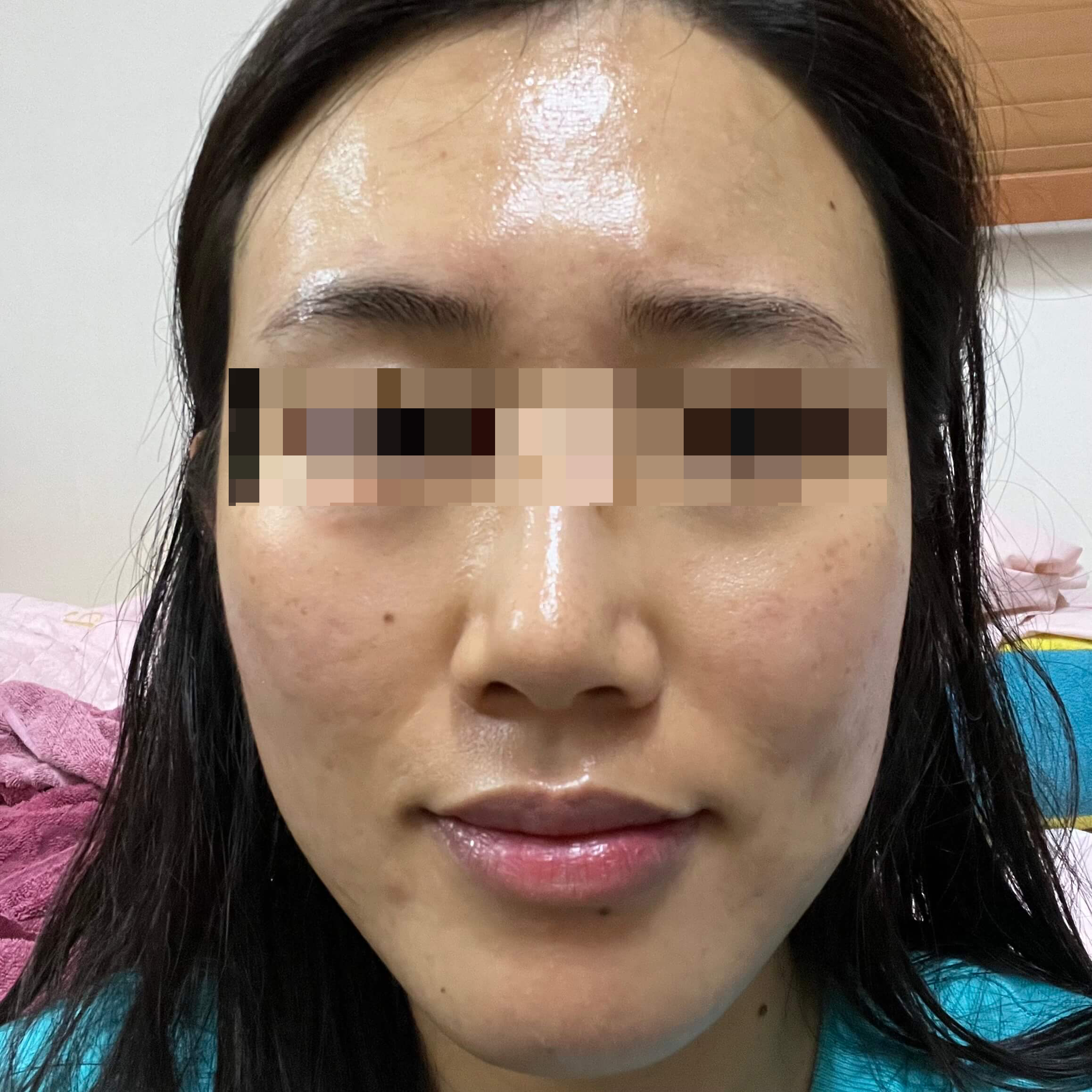 여드름약 복용 후