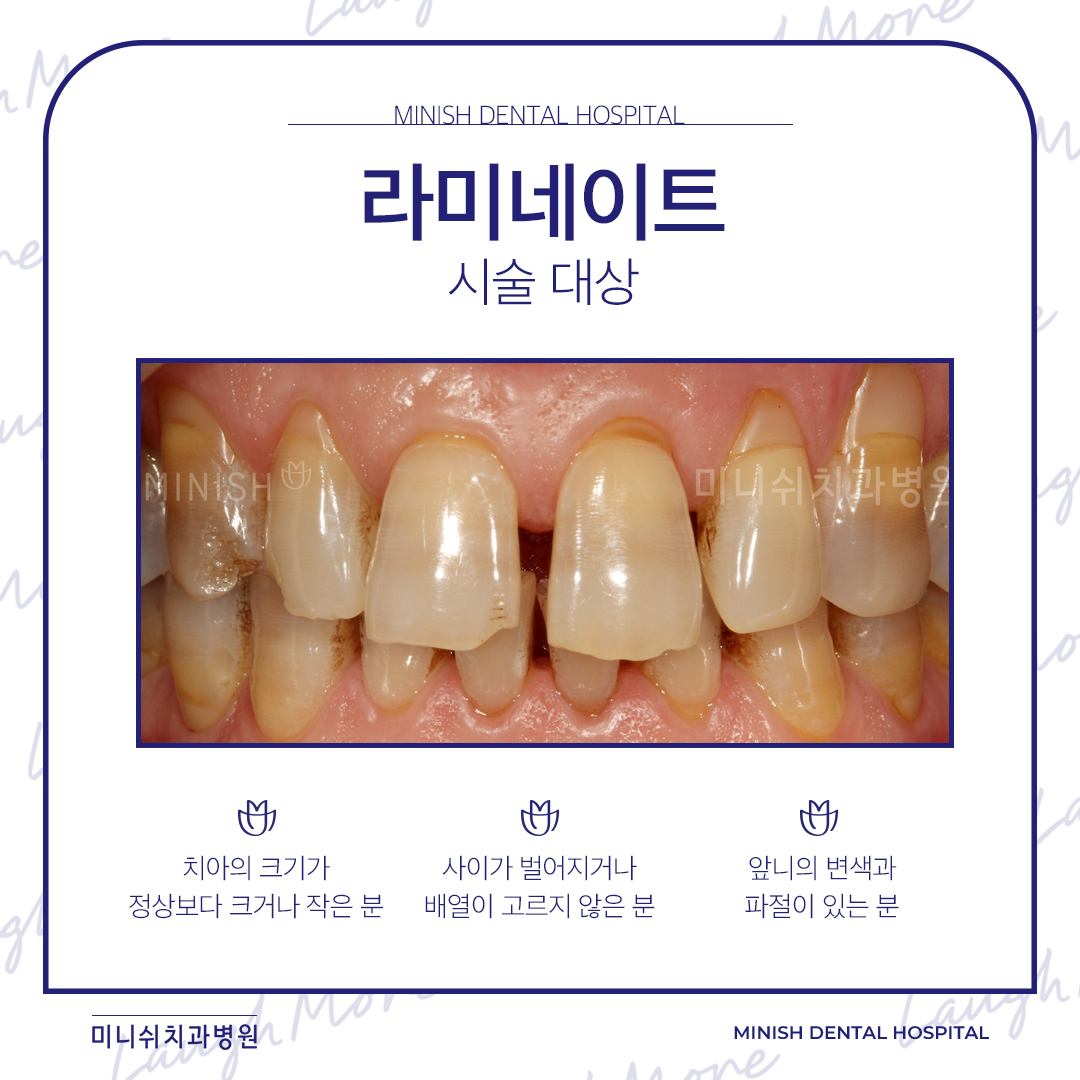 앞니 라미네이트 / 연예인 치아성형 2