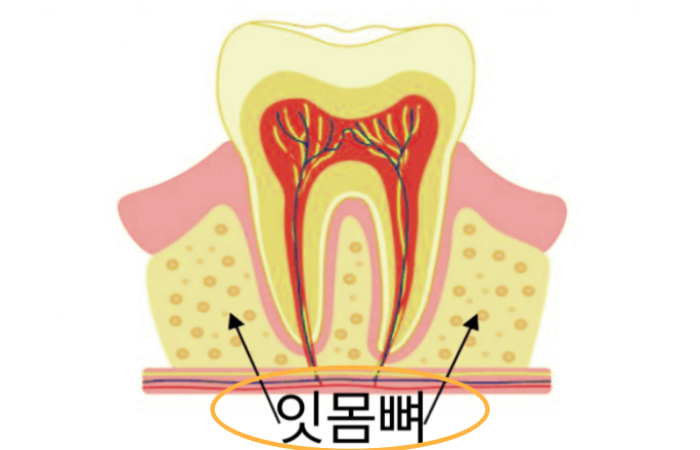 임플란트-고정체를-잡아주는-잇몸뼈