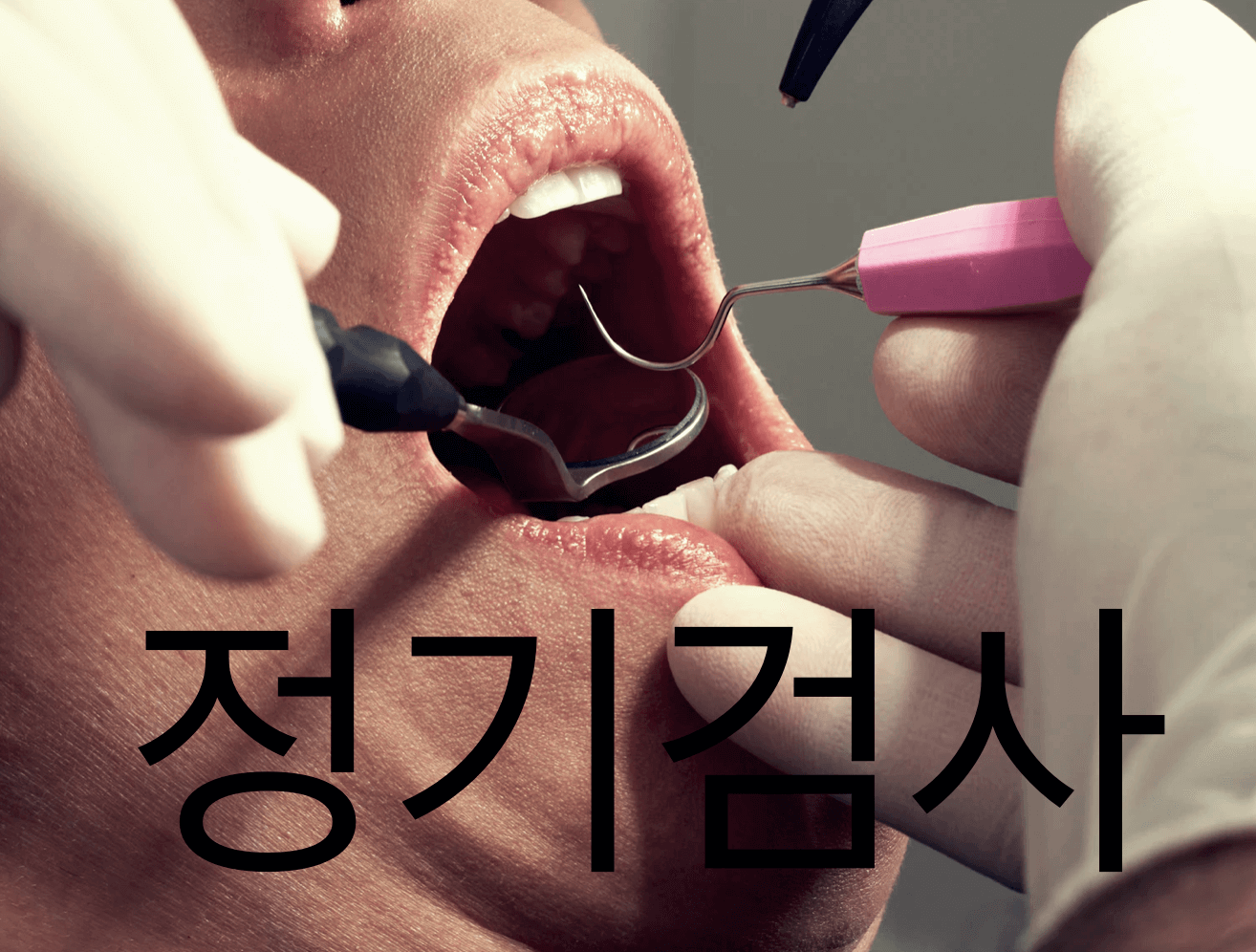 임플란트-수명을-늘려주는-치과-정기검사