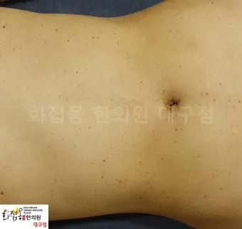 몸에 점이 계속 생기는 이유 원인부터 예방법까지 한눈에_15