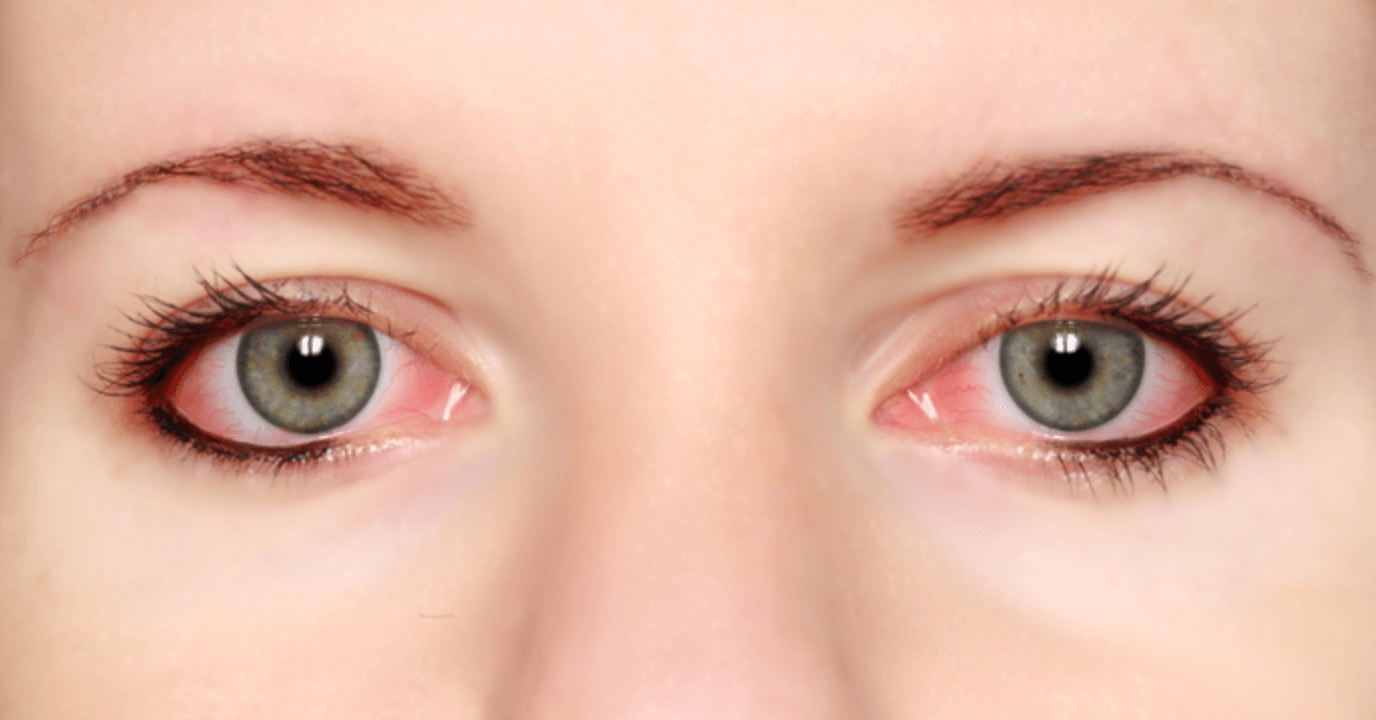눈주변 가려움 치료