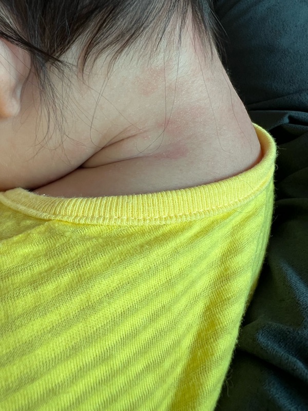 6개월아기-피부트러블
