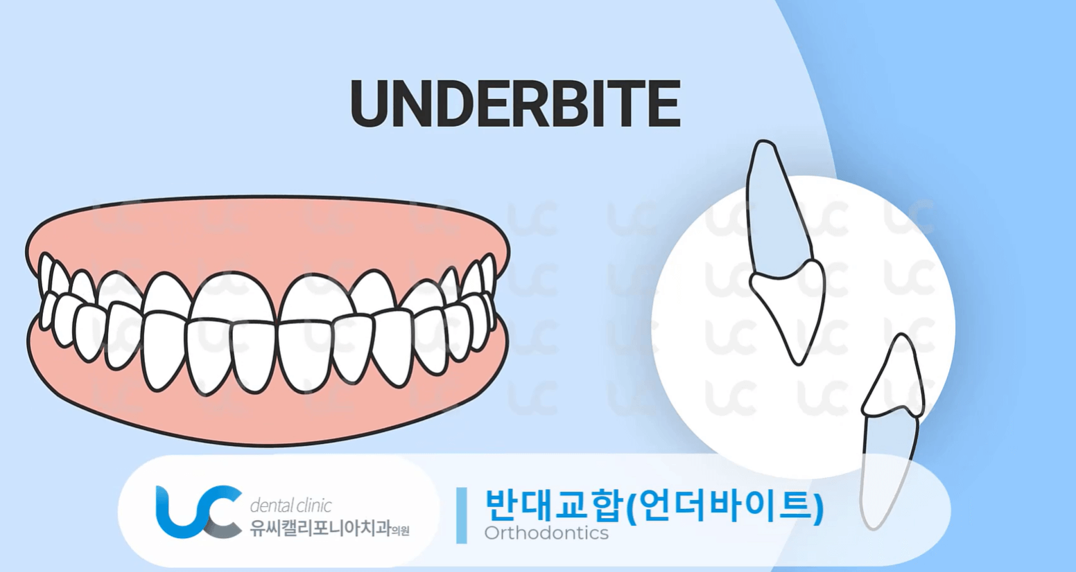 과개교합-치료-안하면