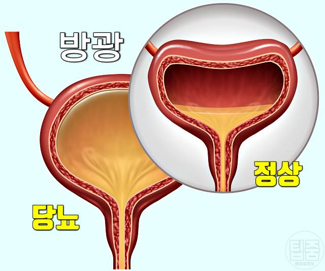 목이 마르는 증상 목이 마르고 갈증이 나는 원인 당뇨병